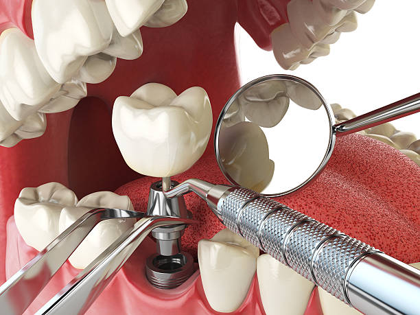 Best Emergency Treatment for Dental Infections or Abscesses in Grand Blanc, MI